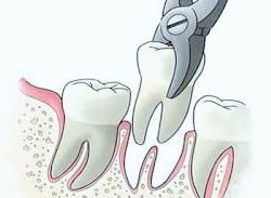 what to expect after a tooth extraction diagram