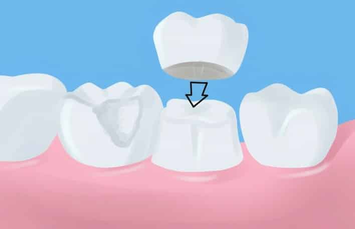Tooth Crown Process Mountain View Dental Pleasant View UT