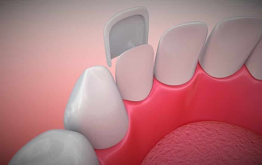 Mountain View Dental best partial dentures