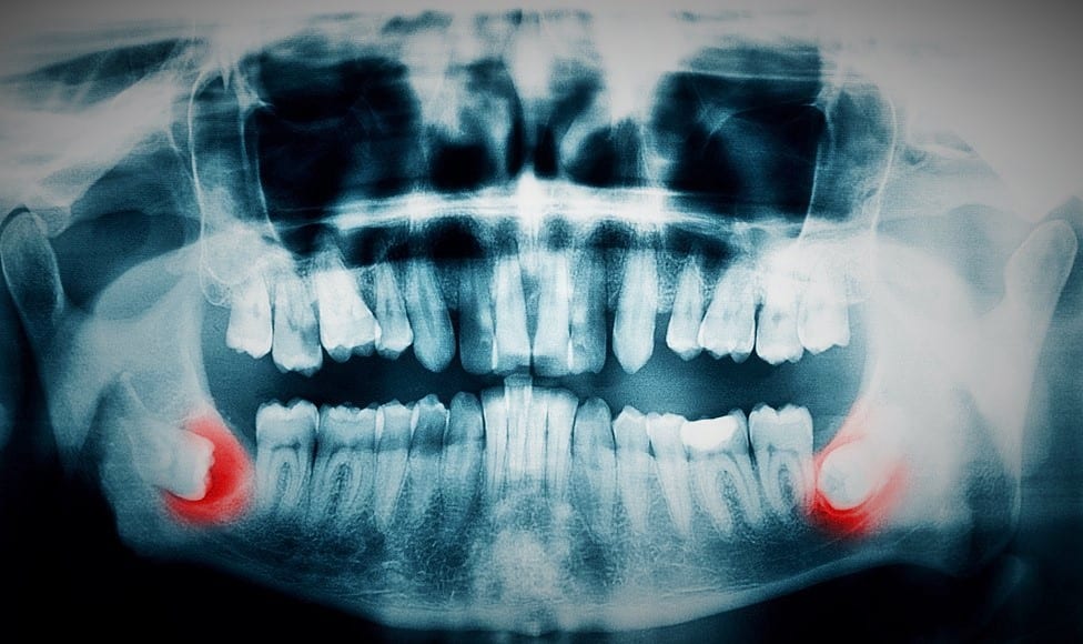digital dental x-ray Mountain View Dental Pleasant View UT