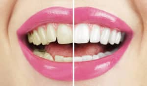 Cosmetic Dentistry (Pleasant View'S Best) Mountain View Dental Teeth Whitening Pleasant View UT
