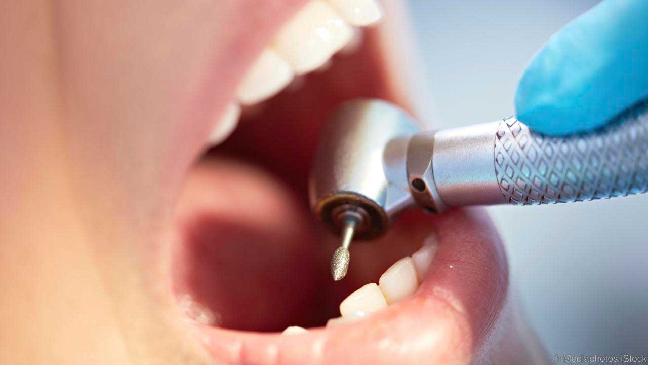 Why Dentists Drill Teeth Mountain View Dental Pleasant View UT