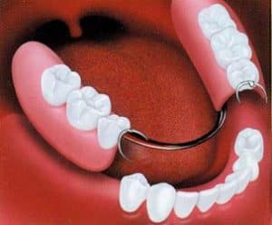best partial dentures types