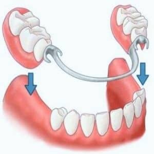 best partial dentures Pleasant View UT Mountain View Dental