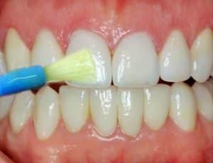 fluoride treatment on teeth