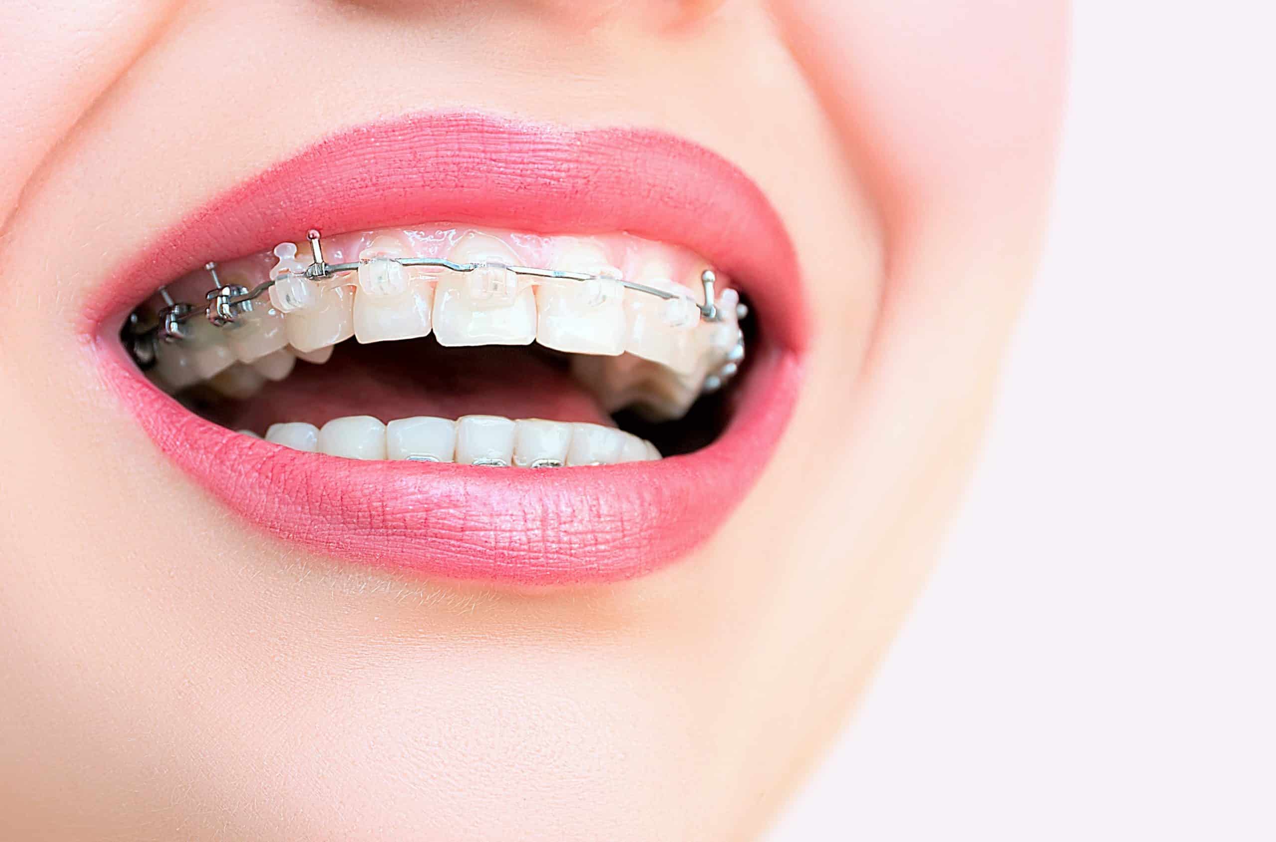 best orthodontist Mountain View Dental Pleasant View UT