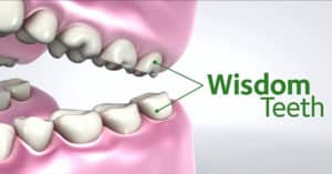 Mountain View Dental Impacted Wisdom Teeth Pleasant View UT