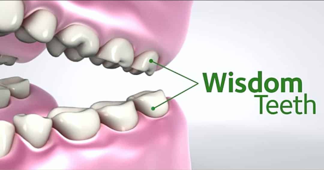 Warning Signs of Impacted Wisdom Teeth Mountain View Dental Pleasant View UT