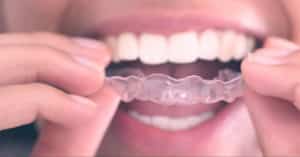 Mountain View Dental Straighten Teeth Pleasant View UT