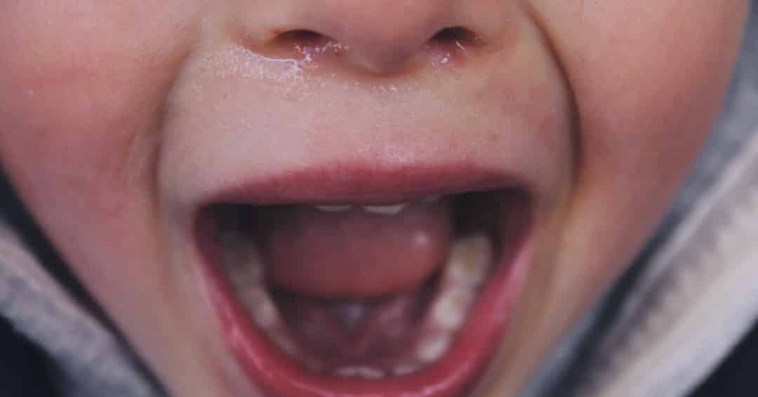 How to Heal Canker Sores Mountain View Dental Pleasant View UT