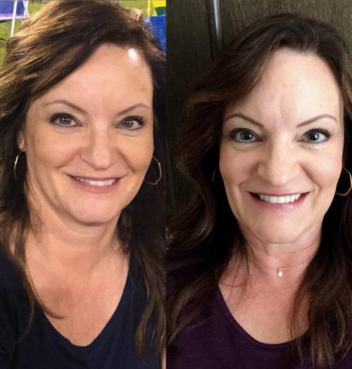 Smile Makeover 2