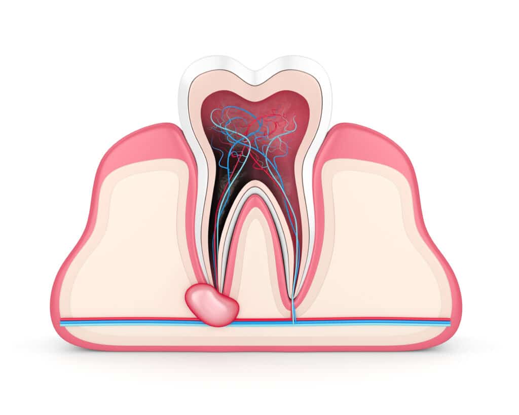 Tooth abscess
