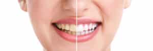 Are Teeth Naturally Yellow Or White? Mountain View Dental naturally yellow Pleasant View, UT