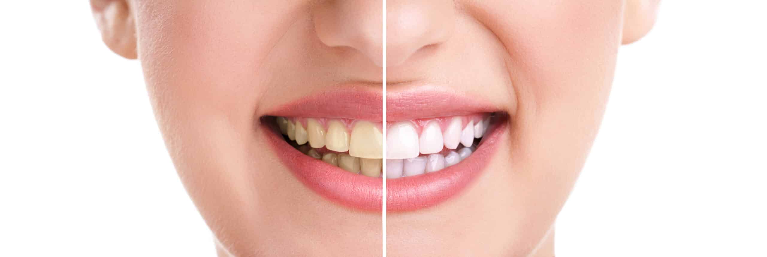 woman teeth and smile, close up, isolated on white, whitening treatment. Are Teeth Naturally Yellow or White?