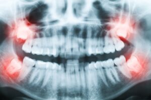 5 Things To Know About Wisdom Teeth Extractions Mountain View Dental Wisdom Teeth Extraction Pleasant View, UT