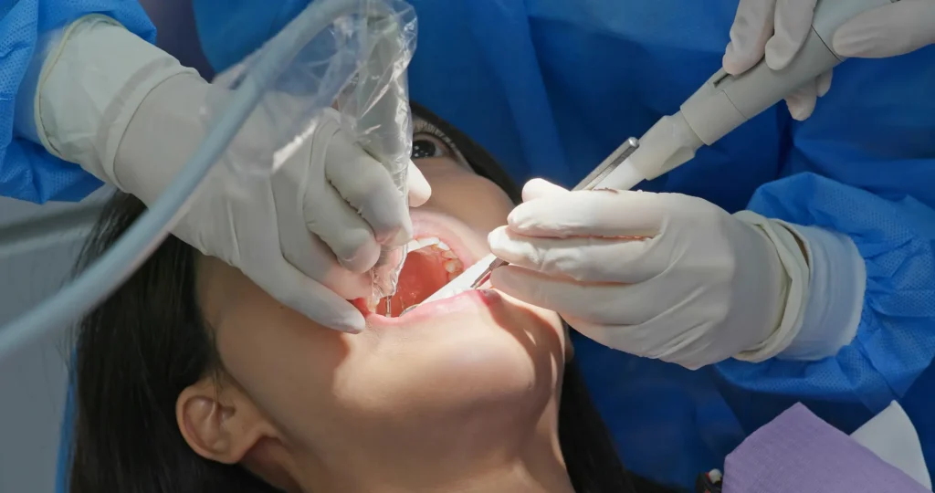 root canals
