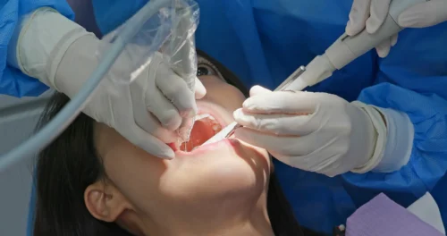 root canals