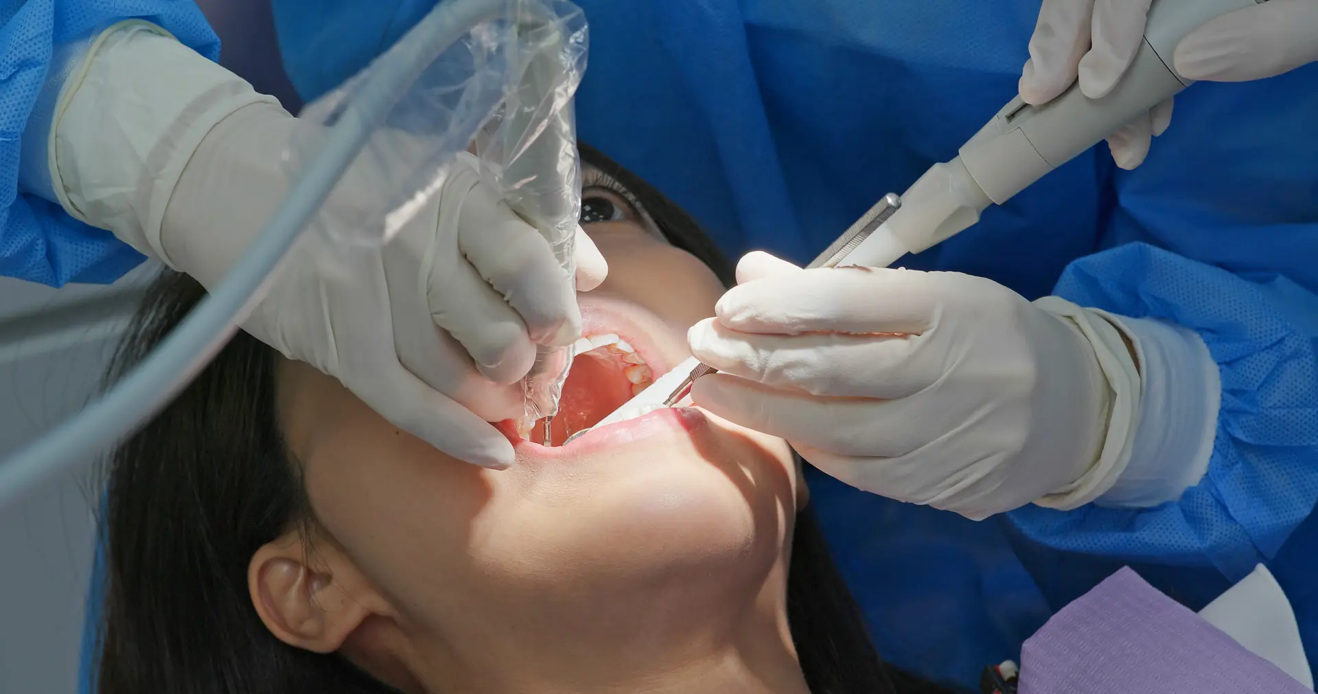 Root Canals root canals