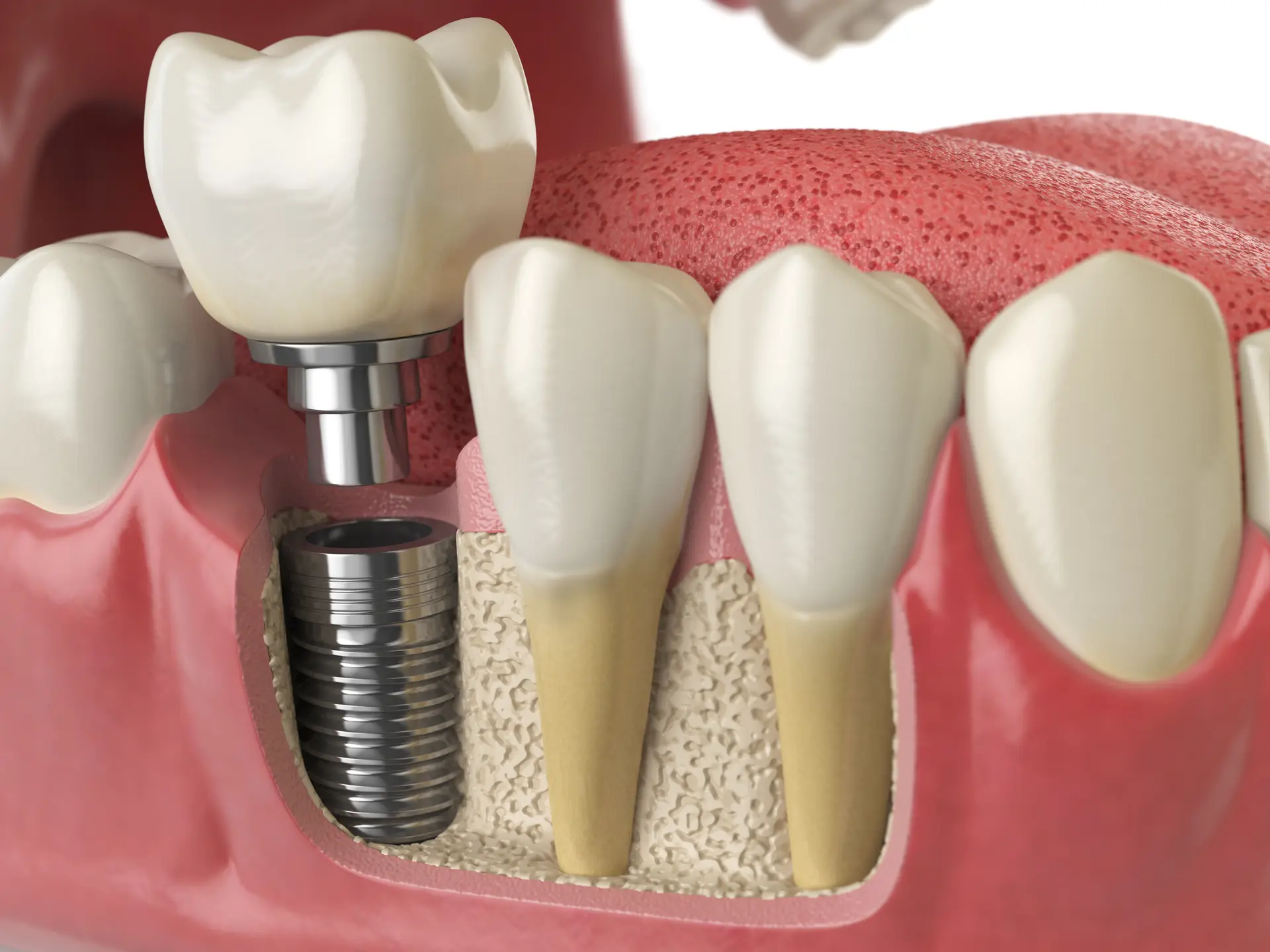 Dental Implants in North Ogden and Pleasant View