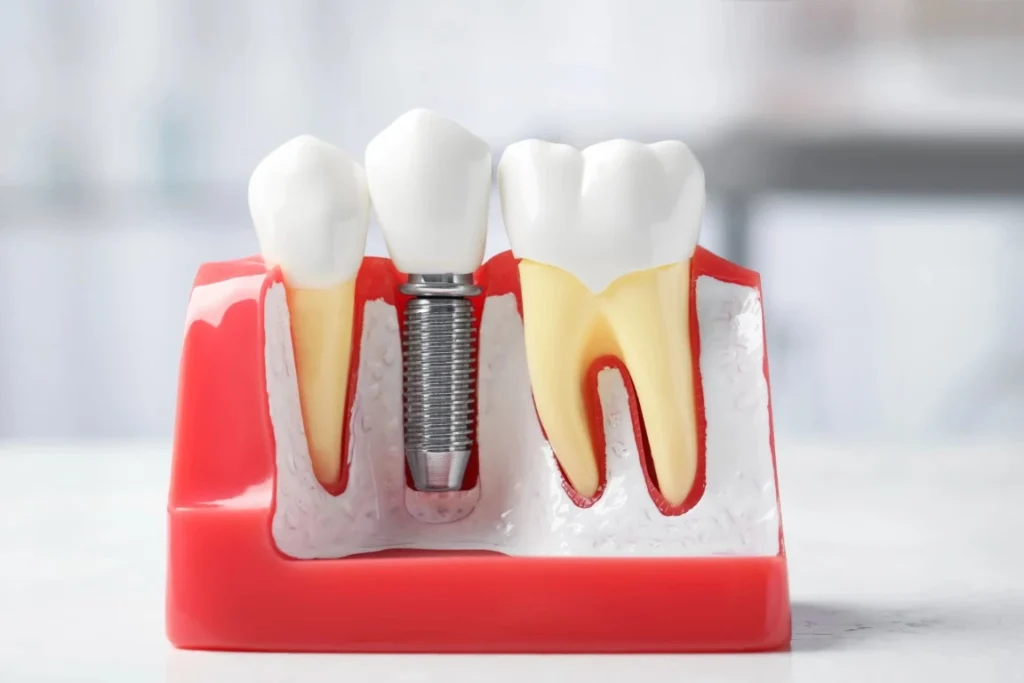 Dental Implant - North Ogden, Utah