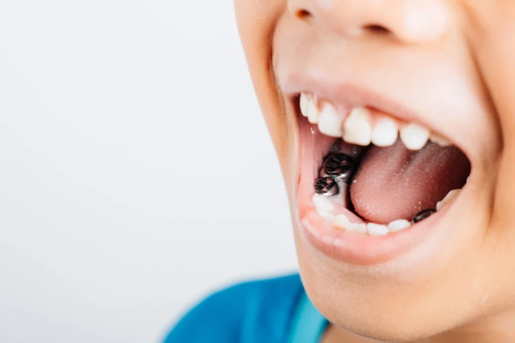 Amalgam Vs. Composite Fillings: Which Is Best For Your Long-Term Oral Health Composite Fillings - Ogden, UT
