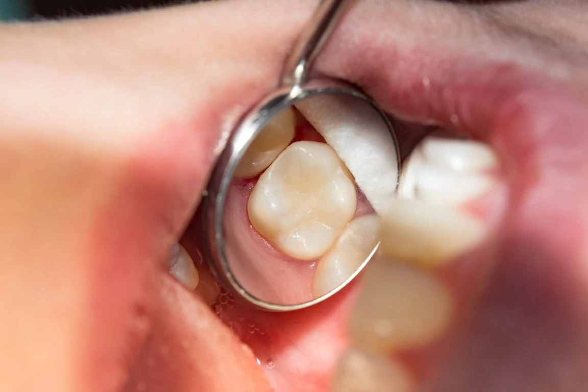 Amalgam Vs. Composite Fillings: Which Is Best For Your Long-Term Oral Health Composite Fillings - Ogden, UT